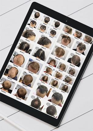 general mens womens hair loss treatment success stories The Belgravia Hair Loss Clinic London