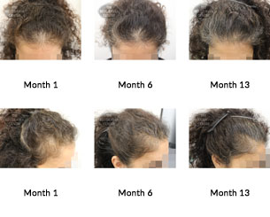 alert female pattern hair loss the belgravia centre 363639 02 07 2019