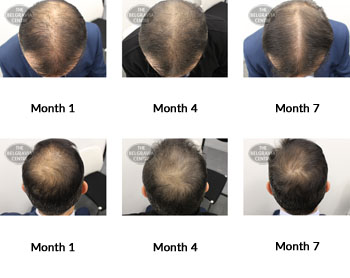 alert male pattern hair loss the belgravia centre 373337 02 07 2019