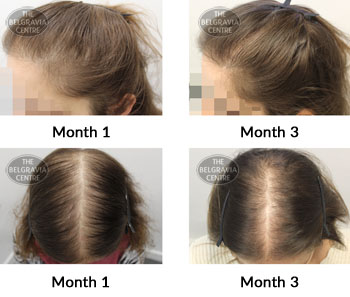 alert female pattern hair loss the belgravia centre 301395 24 06 2019