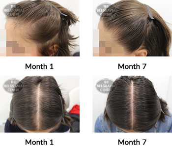 alert female pattern hair loss the belgravia centre 374873 21 06 2019