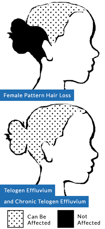 Types of Womens Hair Loss - Areas of Scalp Affected by Temporary and Permanent HairLoss Conditions