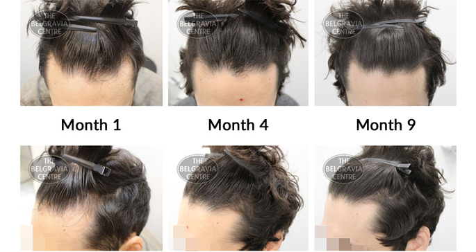 Is Hair Loss Near Cowlick Normal?'