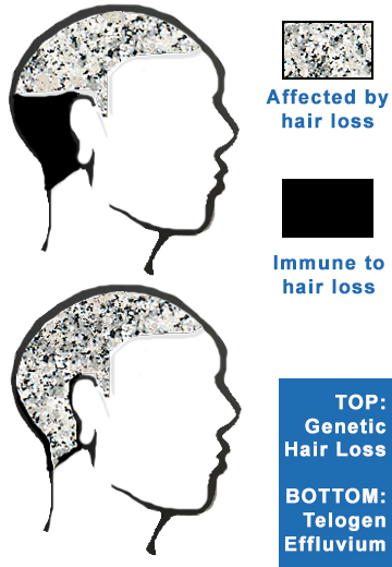Areas of scalp affected by genetic hair loss and telogen effluvium temporary permanent baldness diagram