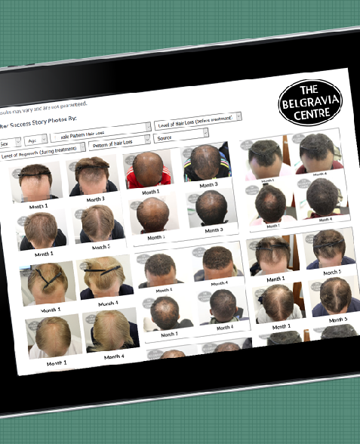 Belgravia Centre - Male Pattern Hair Loss Treatment Success Stories ipad photo
