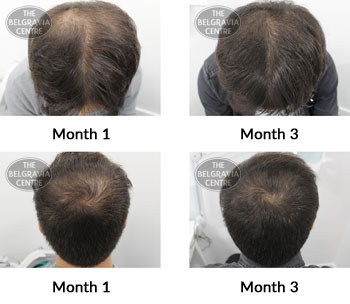 alert male pattern hair loss the belgravia centre 378066 17 06 2019