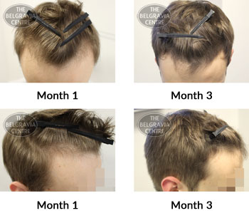 alert male pattern hair loss the belgravia centre 380140 12 06 2019