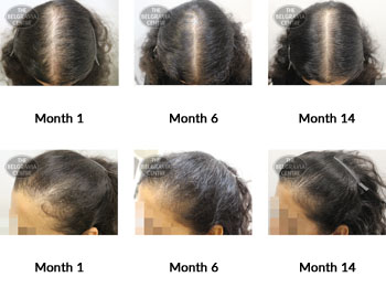 alert female pattern hair loss the belgravia centre 350141 11 06 2019