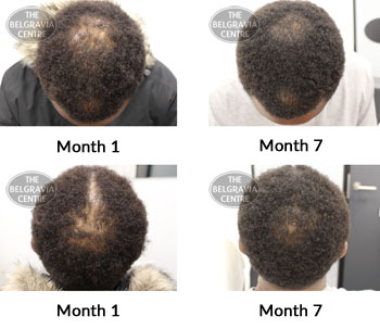 alert male pattern hair loss the belgravia centre 373989 11 06 2019