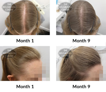 alert diffuse hair loss and female pattern hair loss the belgravia centre 368707 11 06 2019
