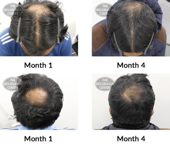 alert male pattern hair loss the belgravia centre 374447 04 06 2019