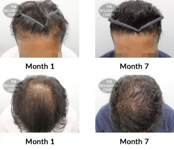 alert male pattern hair loss the belgravia centre 370844 28 05 2019