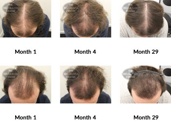 alert male pattern hair loss the belgravia centre 318364 28 05 2019