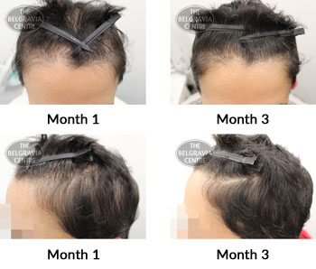 alert female pattern hair loss the belgravia centre 379064 24 05 2019