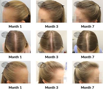 alert female pattern hair loss the belgravia centre 345718 21 05 2019