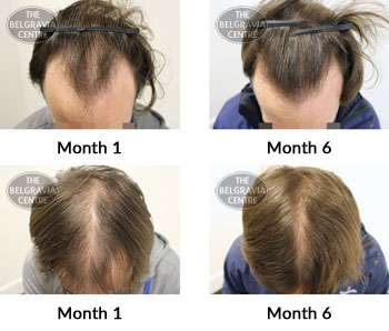 alert male pattern hair loss the belgravia centre 371552 20 05 2019