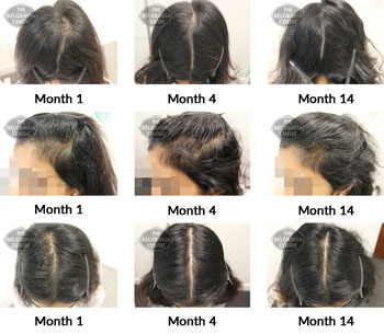 alert female pattern hair loss the belgravia centre 352291 20 05 2019