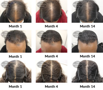 alert female pattern hair loss the belgravia centre 356066 08 05 2019