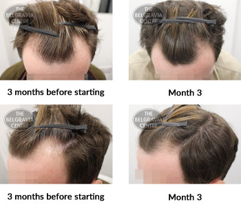 alert male pattern hair loss the belgravia centre 371277 08 05 2019