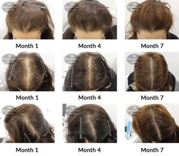 Success Story Alert! New Female Hair Loss Treatment Entry