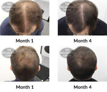 alert male pattern hair loss the belgravia centre 376044 29 04 2019