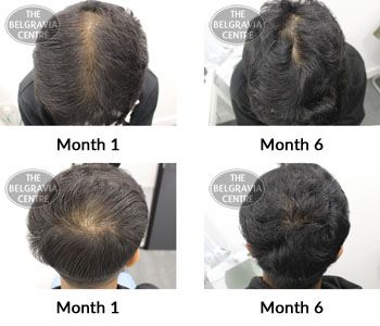 alert male pattern hair loss the belgravia centre 371363 29 04 2019