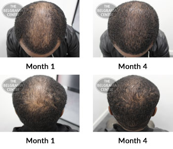 alert male pattern hair loss the belgravia centre 219682 23 04 2019