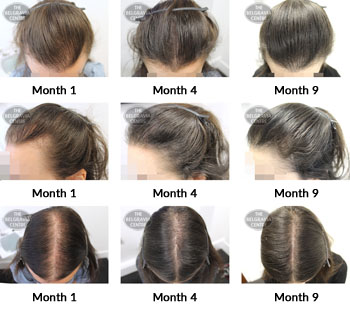 alert female pattern hair loss the belgravia centre 366309 23 04 2019