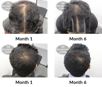 alert male pattern hair loss the belgravia centre 372230 23 04 2019