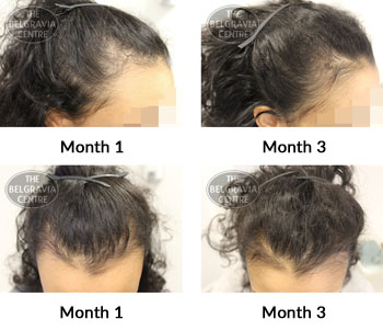 alert female pattern hair loss the belgravia centre 375335 18 04 2019