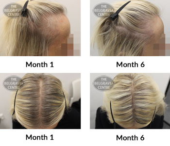 alert female pattern hair loss the belgravia centre 372554 15 04 2019