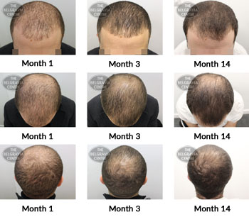 alert male pattern hair loss the belgravia centre 355249 11 04 2019