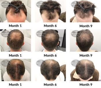 alert male pattern hair loss the belgravia centre 365365 08 04 2019