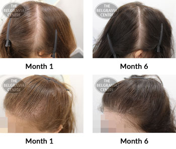 alert female pattern hair loss and diffuse thinning the belgravia centre 04 04 2019