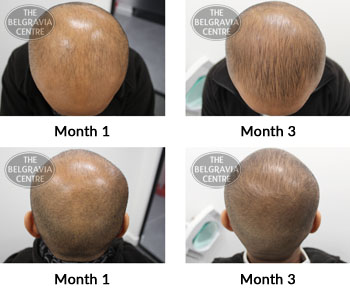 alert male pattern hair loss the belgravia centre 374051 03 04 2019
