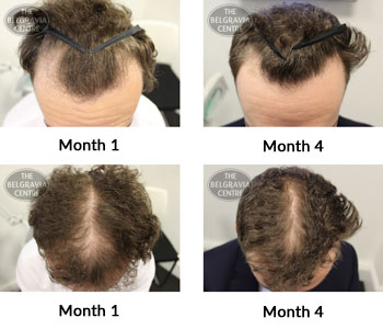 alert male pattern hair loss the belgravia centre 375049 29 03 2019