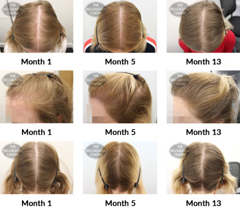 alert female pattern hair loss the belgravia centre 353315 29 03 2019