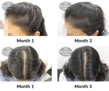alert female pattern hair loss the belgravia centre 375473 27 03 2019