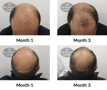 alert male pattern hair loss the belgravia centre 375772 25 03 2019