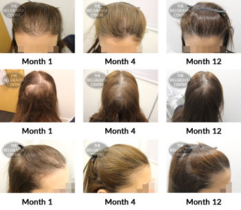 alert female pattern hair loss the belgravia centre 356545 25 03 2019