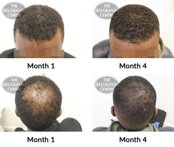 alert male pattern hair loss the belgravia centre 373611 22 03 2019