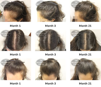 alert female pattern hair loss the belgravia centre 338258 21 03 2019