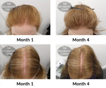 alert female pattern hair loss and diffuse thinning the belgravia centre 374906 11 03 2019