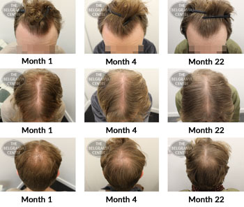 alert male pattern hair loss the belgravia centre 336500 06 03 2019