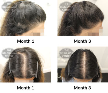 alert female pattern hair loss the belgravia centre 374115 04 03 2019