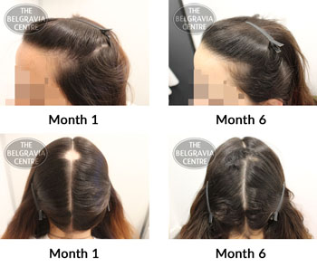 alert alopecia areata and female pattern hair loss the belgravia centre 368258 28 02 2019 1