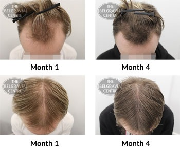 alert male pattern hair loss the belgravia centre 374179 25 02 2019
