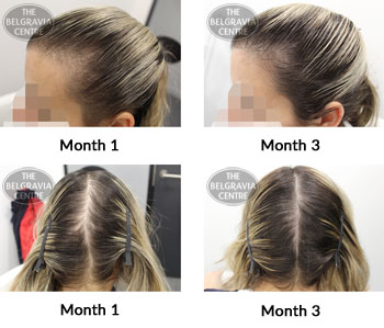 alert post partum alopecia and female pattern hair loss the belgravia centre 374136 21 02 2019