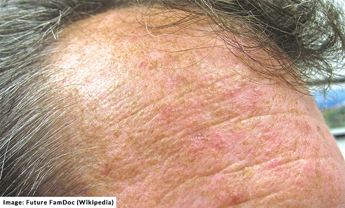 Actinic keratoses on scalp condition can be sign of pre-cancer skin cancer