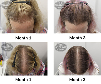 ALERT - female pattern hair loss the belgravia centre TM 18 02 2019
